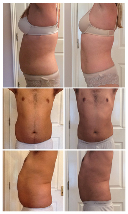 3D LIPO Before and After