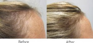 Viviscal Professional Before and After
