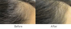 Viviscale Professional Before and After