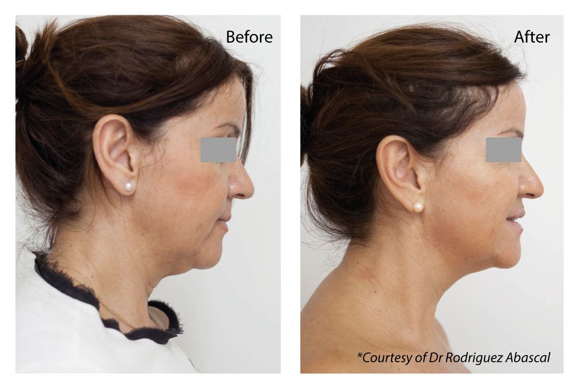 Profhilo for neck before and after