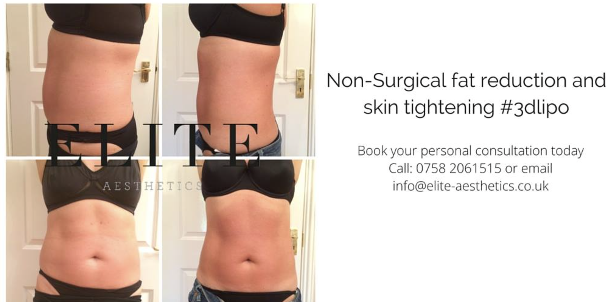 3D Lipo to Reduce Fat this January