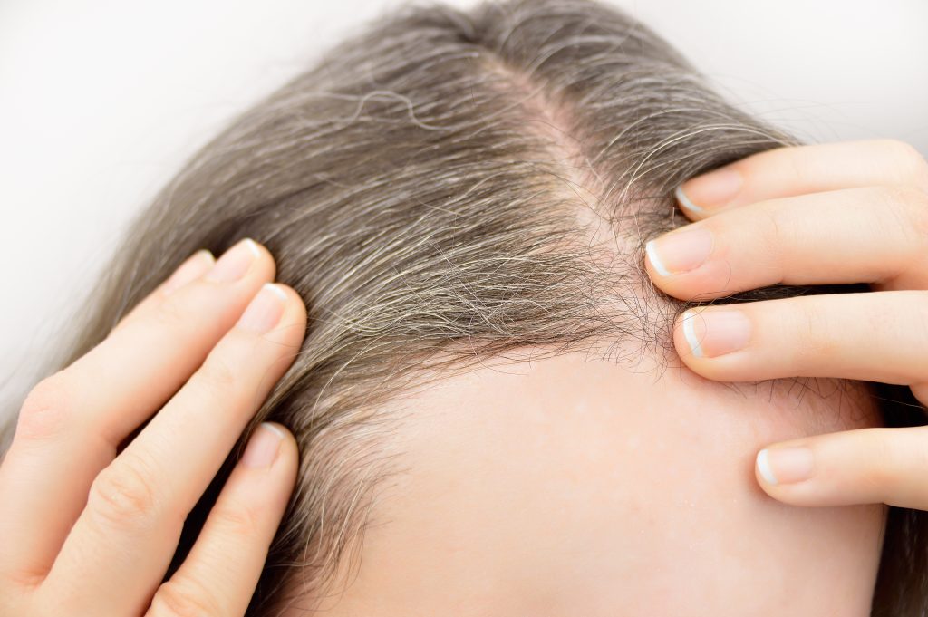 Hair restoration for women