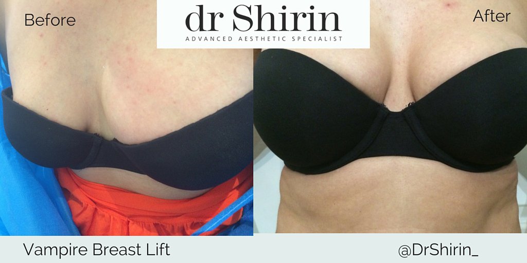 Vampire Breast Lift Before and After