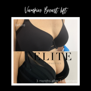 Vampire Breast Lift Before and After