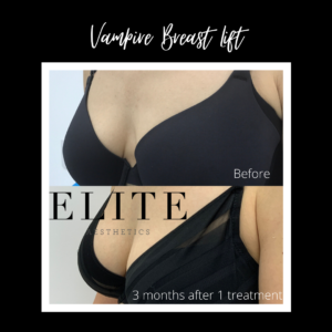 non surgical breast lift before and after 2