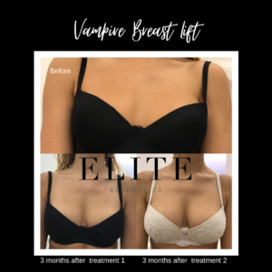 non surgical breast lift before and after