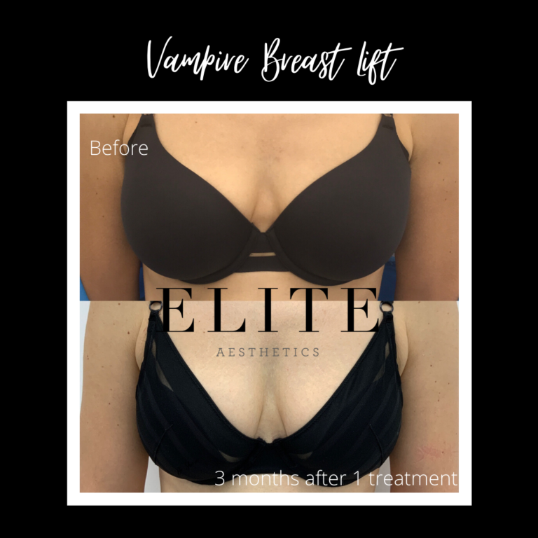 Vampire breast lift Perkier cleavage Elite Aesthetics