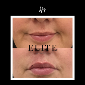Fillers for the lip before & after