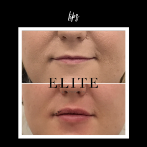 Fillers for the lip before & after