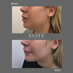Fat Freezing Chin