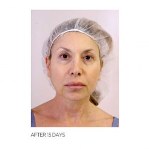 Thread Lift Woman After 15 Days