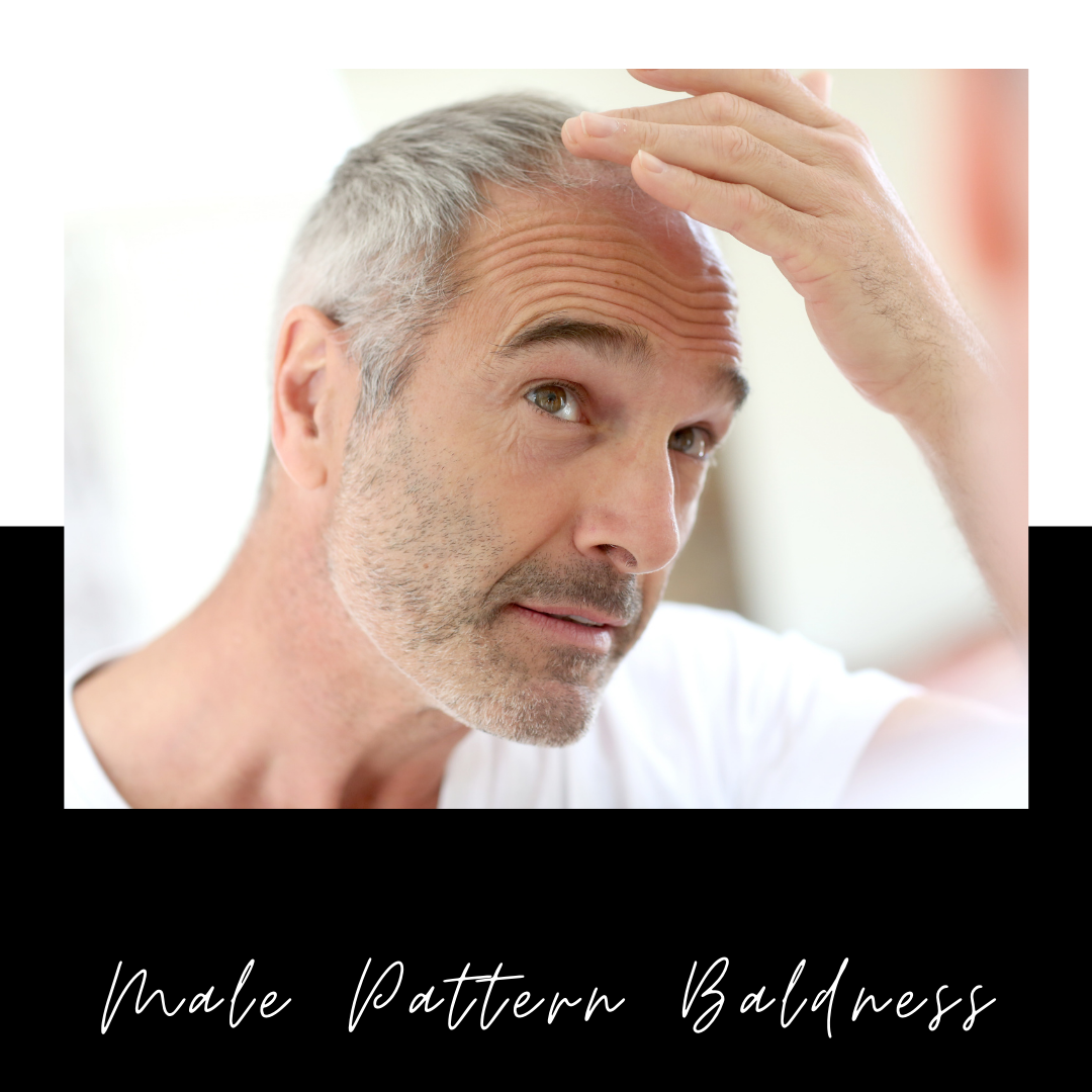 Male Pattern Baldness – Is There A Non-Surgical Solution?