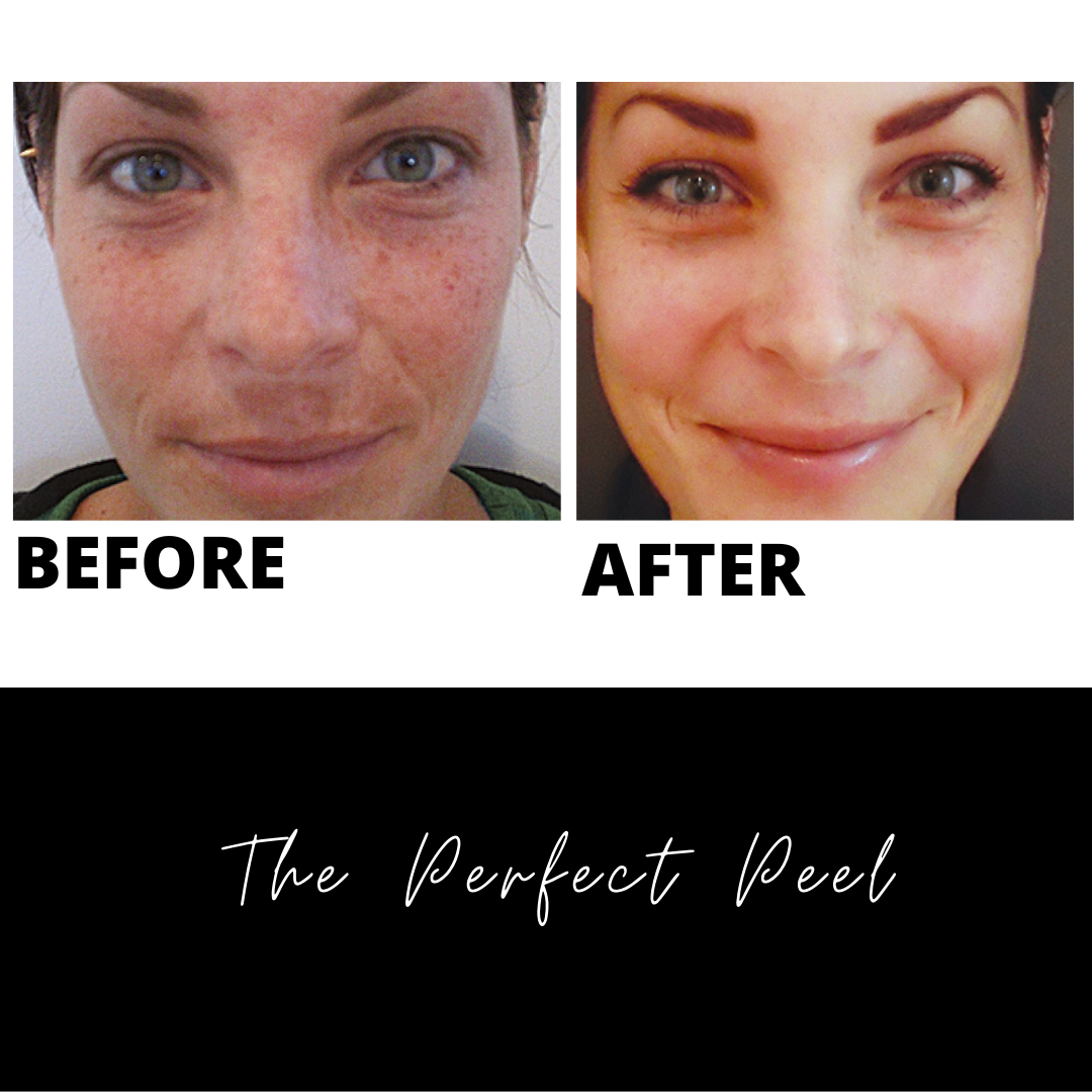 The Perfect Peel – The Barefaced Facts