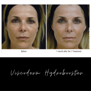 Viscoderm Hydrobooster Befoer and After