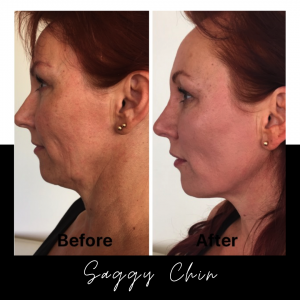 Saggy Chin Treatment