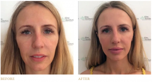 before and after 8-point facelift 
