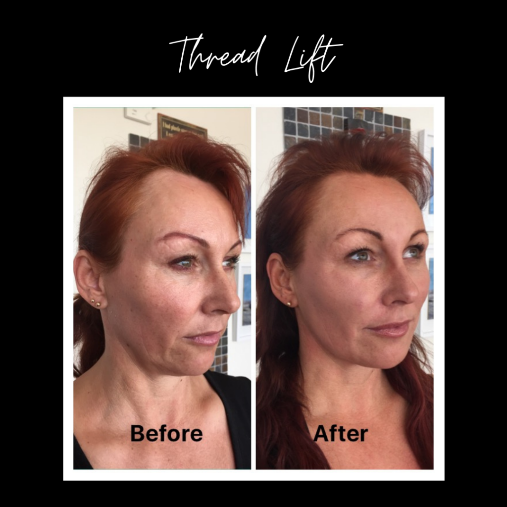 PDO Threading Kent London Non Surgical Thread Life Facelifts UK Private Clinic Maidstone Darthmouth