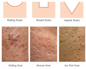 Different type of acne scars