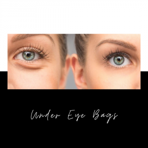 Under eye bags 