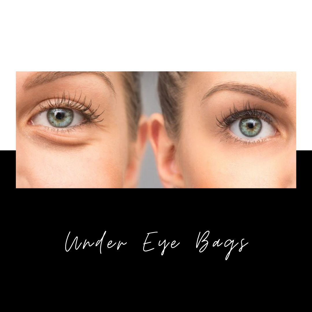 Bags Under Eyes? Causes, Treatment & Solutions