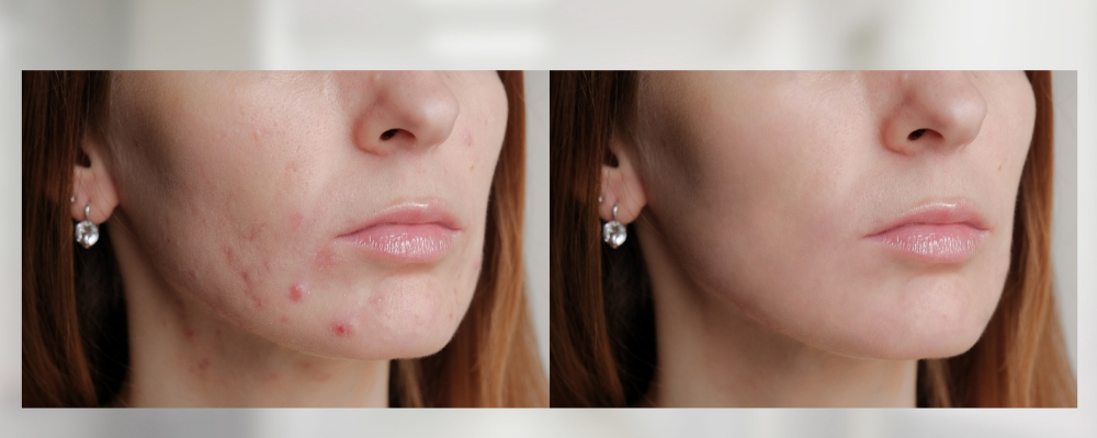 Chemical Peel Before And After