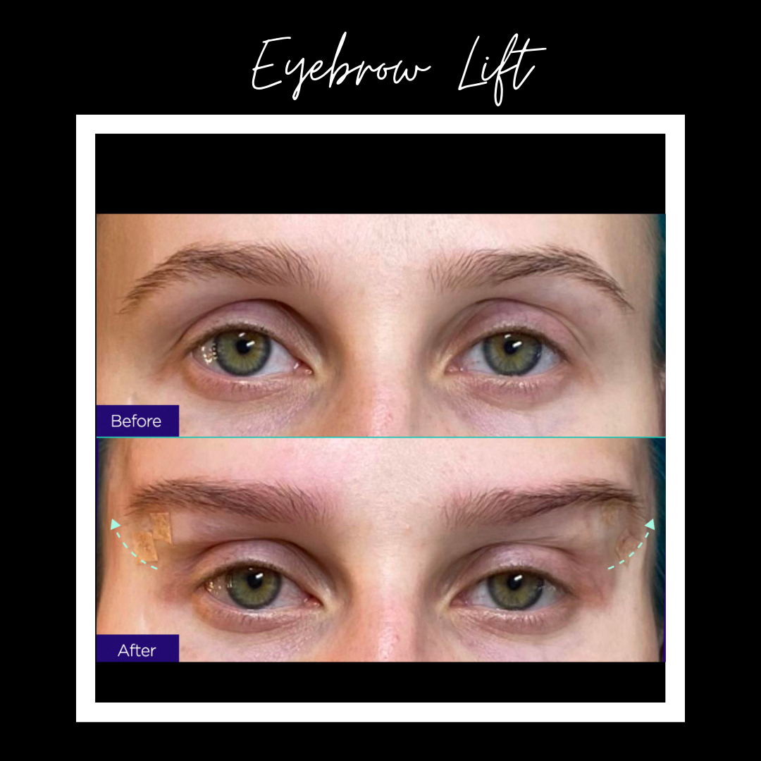 Eyebrow Lift – Everything You Need To Know