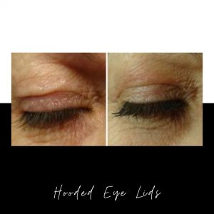 Hooded Eye Lid Treatment