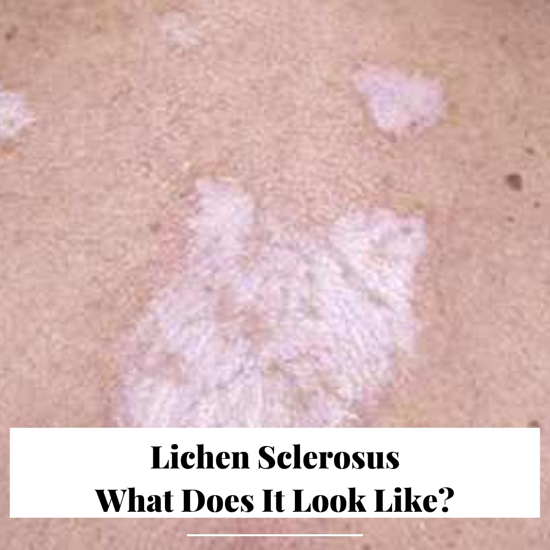 Life expectancy with lichen Sclerosus