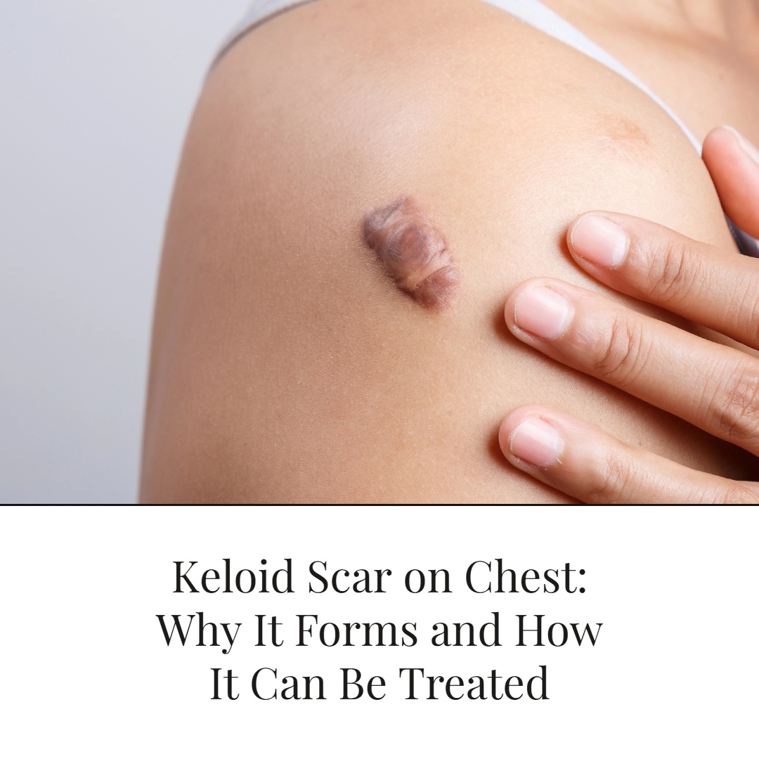 Keloid Scar on Chest: Why It Forms and How It Can Be Treated